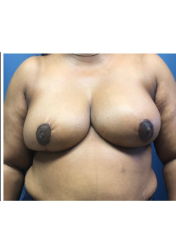 Breast Reduction