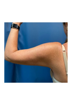 Liposuction of arms
