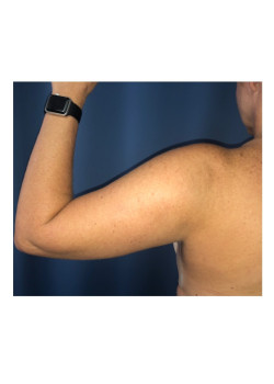Liposuction of arms