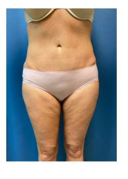 Lipo 360