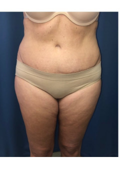 Lipo 360