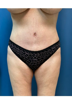 Tummy Tuck with Liposuction