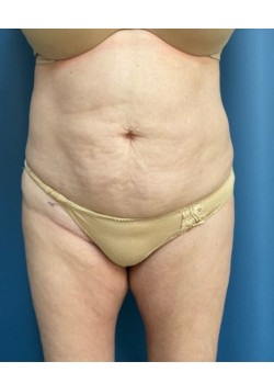 Tummy Tuck with Liposuction