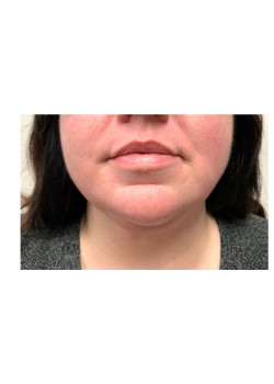 Liposuction of Neck