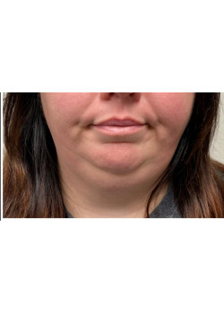 Liposuction of Neck