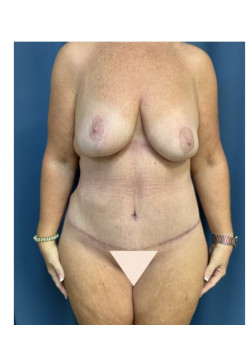 Breast Reduction and Panniculectomy/Abdominoplasty