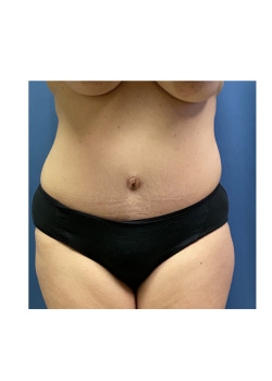 Tummy Tuck with Liposuction