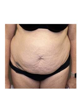 Tummy Tuck with Liposuction