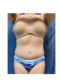 Abdominoplasty with Liposuction