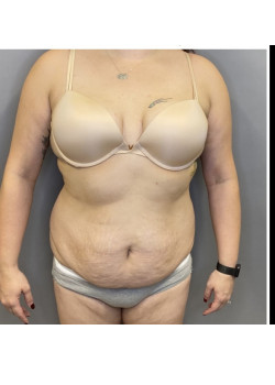 Abdominoplasty with Liposuction