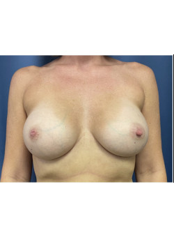 Breast Augmentation