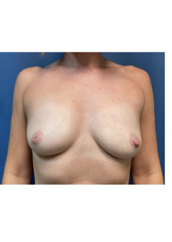 Breast Augmentation