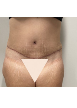 Tummy Tuck