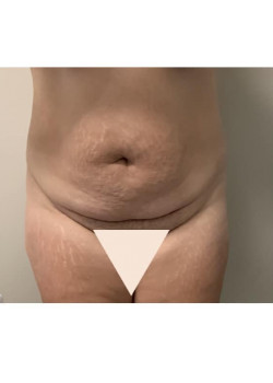 Tummy Tuck