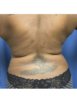 Liposuction