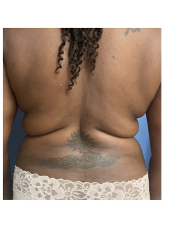 Liposuction