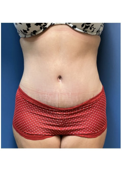 Tummy Tuck and Liposuction