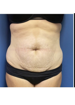 Tummy Tuck and Liposuction