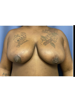 Breast Reduction