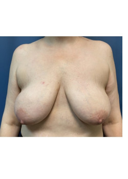 Breast Lift with Implants