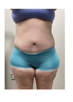 Circumferential Abdominoplasty