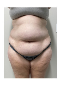 Circumferential Abdominoplasty