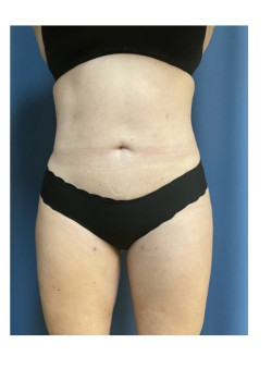 Liposuction