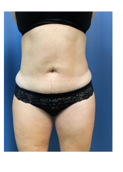 Liposuction