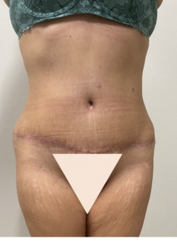 Tummy Tuck and Liposuction