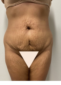 Tummy Tuck and Liposuction