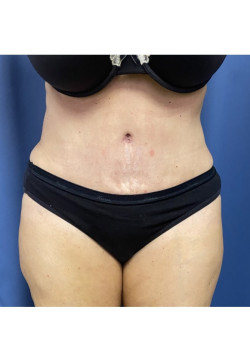 Tummy Tuck with Liposuction