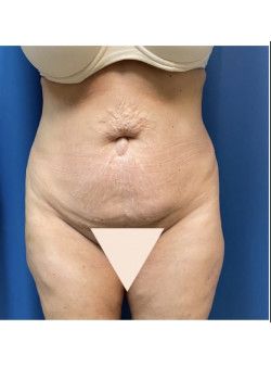 Tummy Tuck with Liposuction