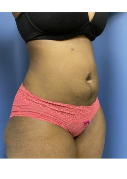 Liposuction
