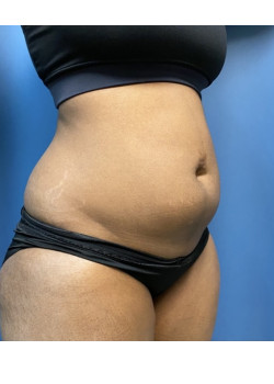 Liposuction