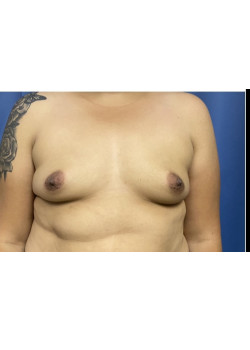 Breast Augmentation