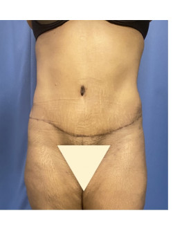 Tummy Tuck