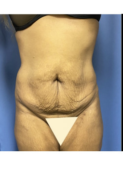 Tummy Tuck
