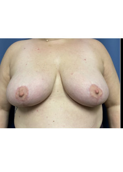 Breast Lift