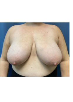 Breast Lift