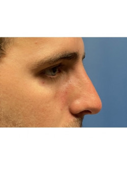 Rhinoplasty