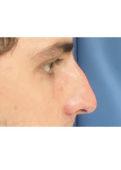 Rhinoplasty