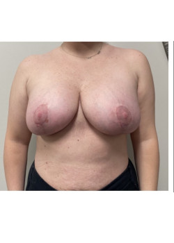 Breast Lift with Implants