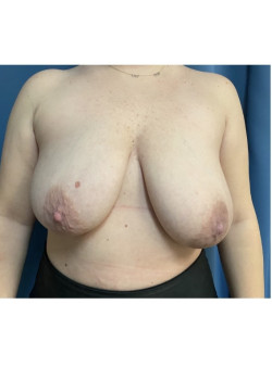 Breast Lift with Implants