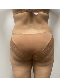 Liposuction and Fat Grafting