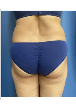 Liposuction and Fat Grafting