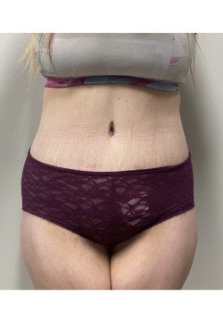 Circumferential Abdominoplasty