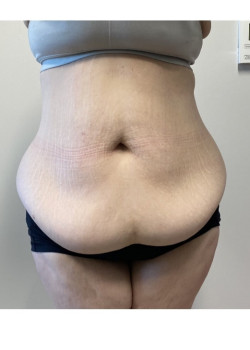 Circumferential Abdominoplasty