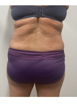 Liposuction
