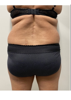 Liposuction