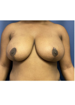 Breast Reduction